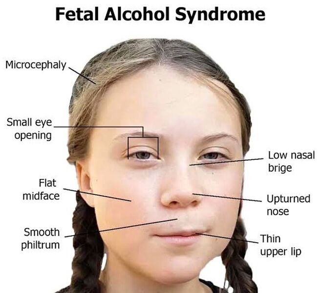 Greta_Thunberg_Fetal_Alcohol_Syndrome.jpg